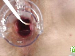 Gyno exam with speculum close up in hairy pussy